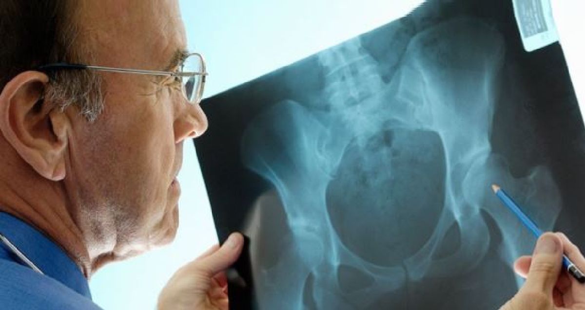 Les Accidents par ostéoporose sont plus nombreux que les accidents de la route.