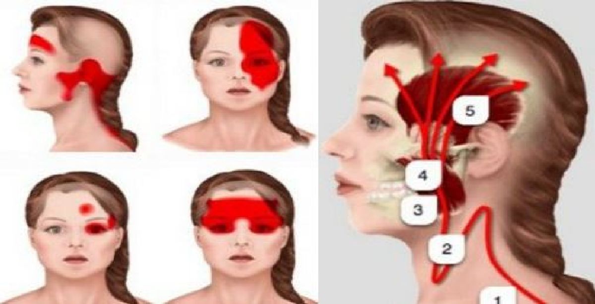 Les premiers signes bizarres d’une migraine