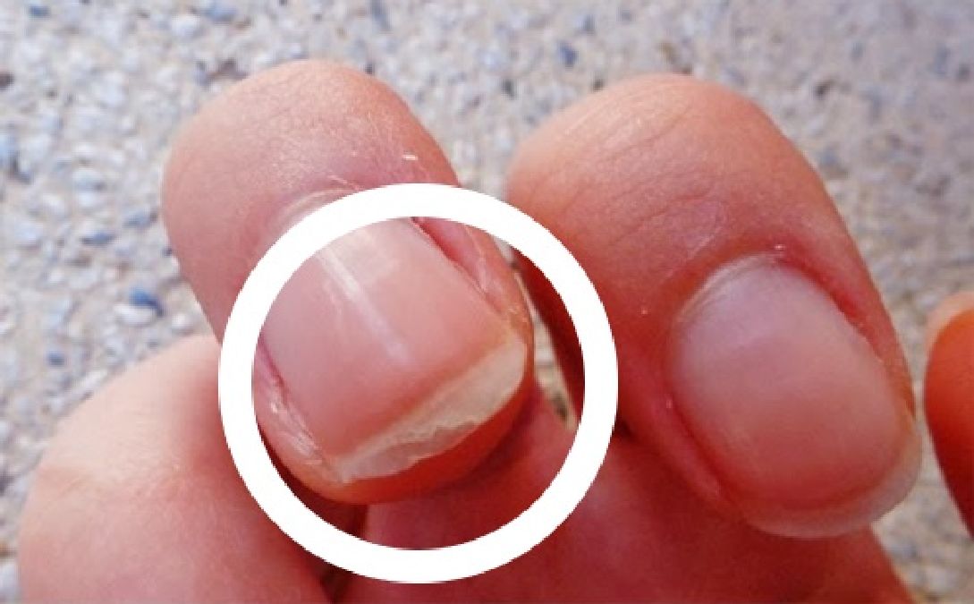 3 Moyens d’empêcher le dédoublement des ongles
