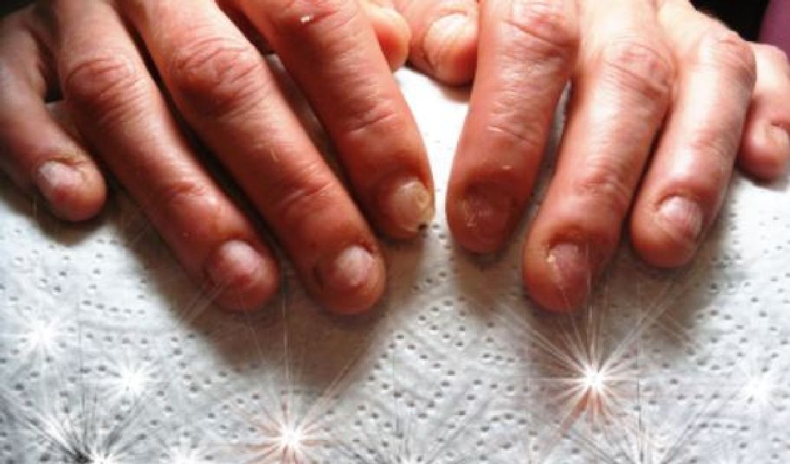 Les chercheurs expliquent :Si vous rongez vos ongles, voici ce que votre personnalité
