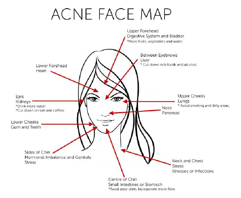 Voilà ce que votre acné révèle sur votre santé