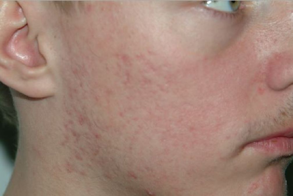 Voici pourquoi les boutons d’acné réapparaissent continuellement