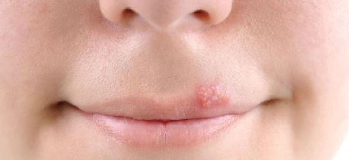 Solution efficace contre l’herpès de la lèvre