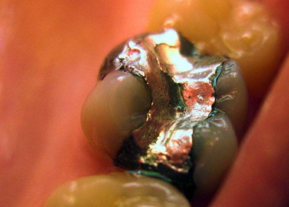 L’assassin dans vos dents : Retirez vos amalgames d’argent et vous serez guéri  beaucoup de maladies