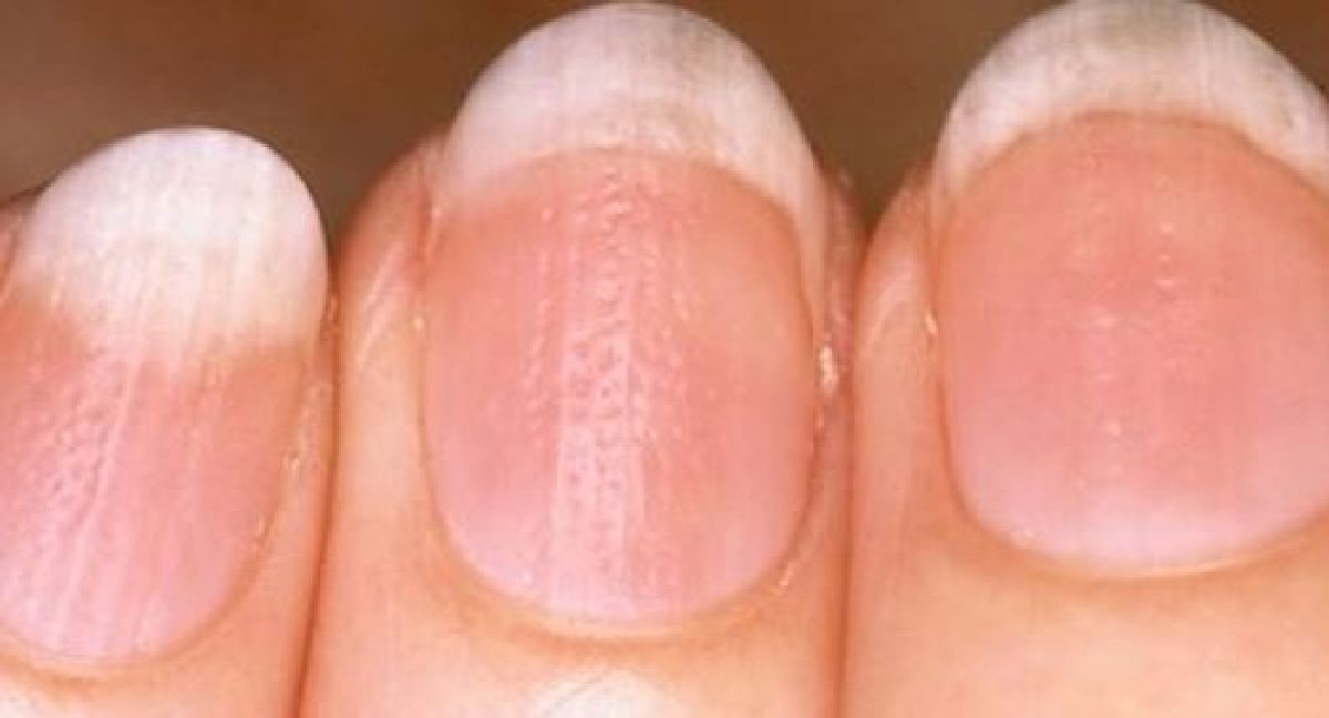 10 Problèmes de santé graves que vos ongles peuvent vous révéler !