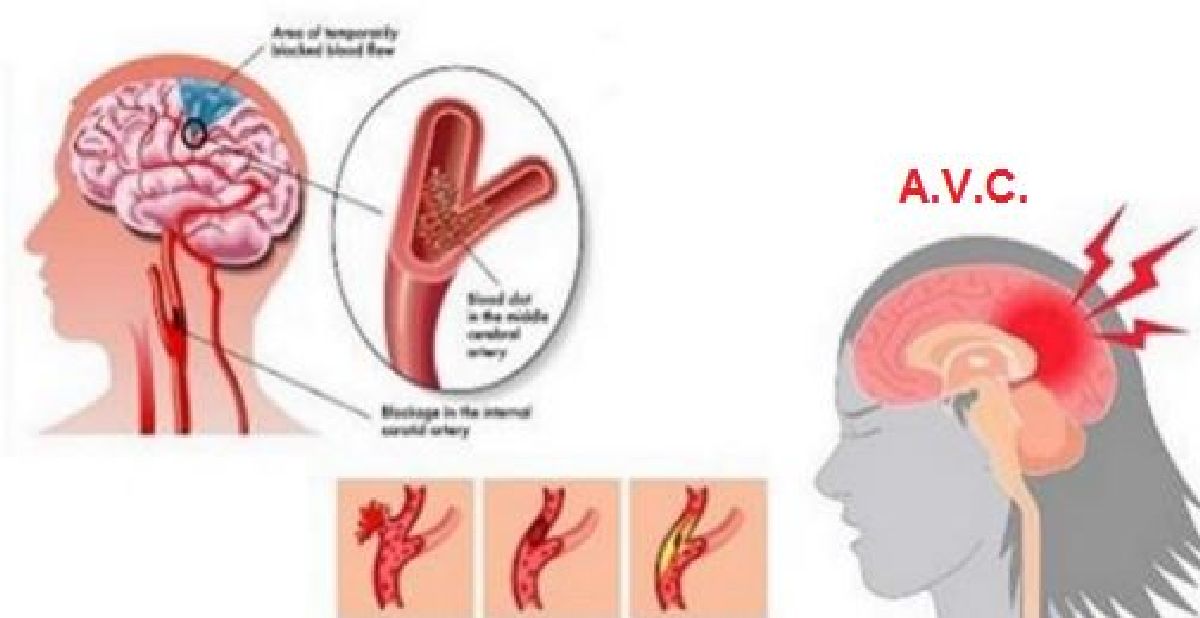 Les 8 signes de l’Accident Vasculaire cérébral