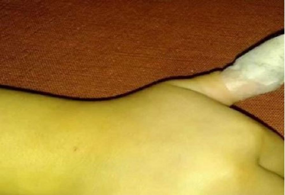 Appliquez une peau de banane sur votre peau…le résultat vous surprendra !