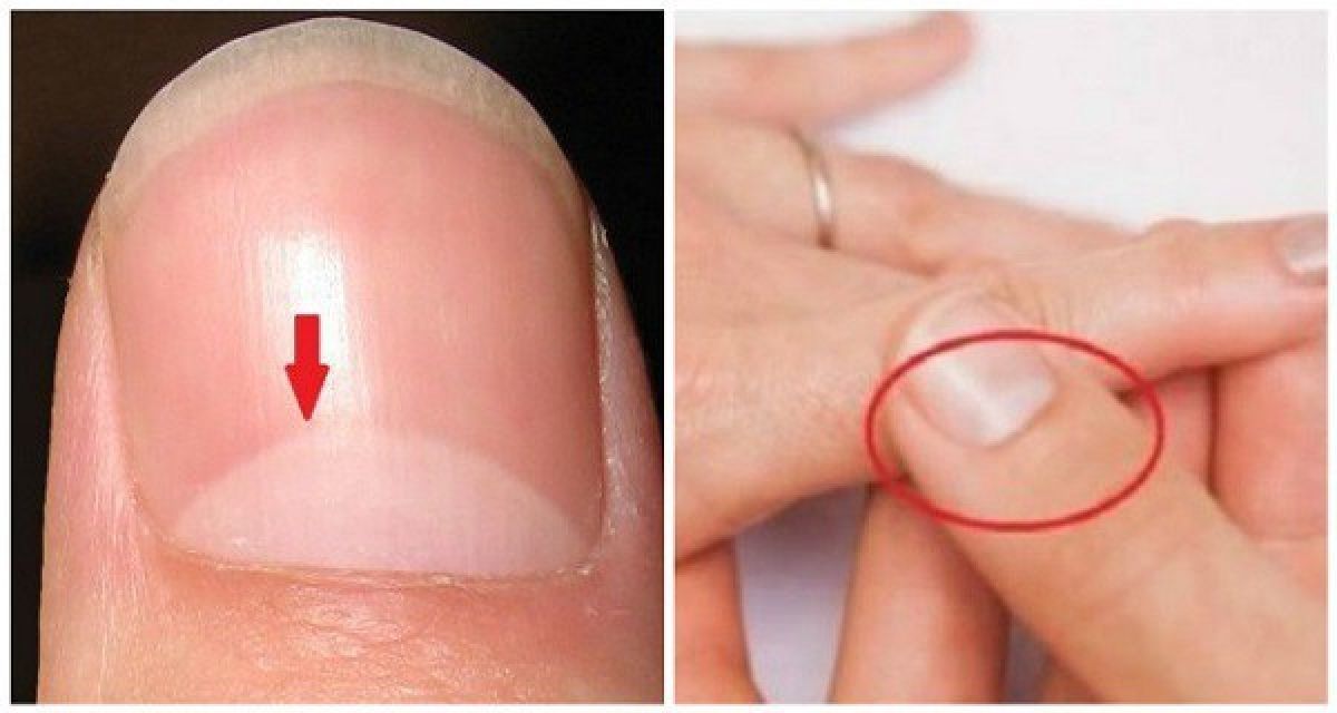 Que signifie ce croissant blanc à la base de votre ongle ?