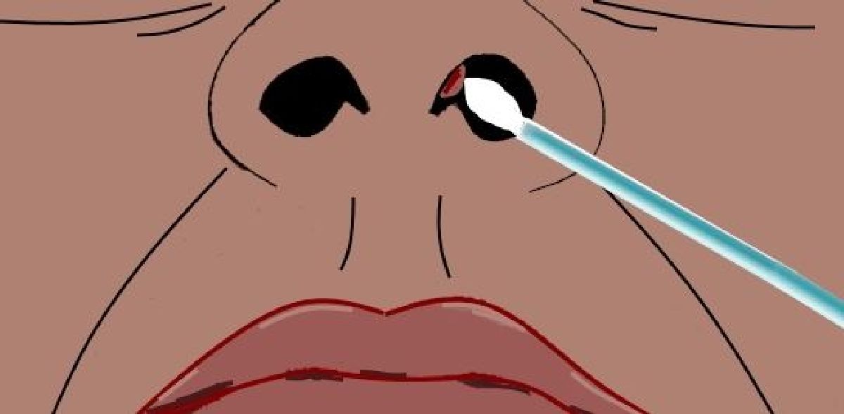 Comment vous débarrasser naturellement et sans douleur d’une bosse à l’intérieur de votre nez ?