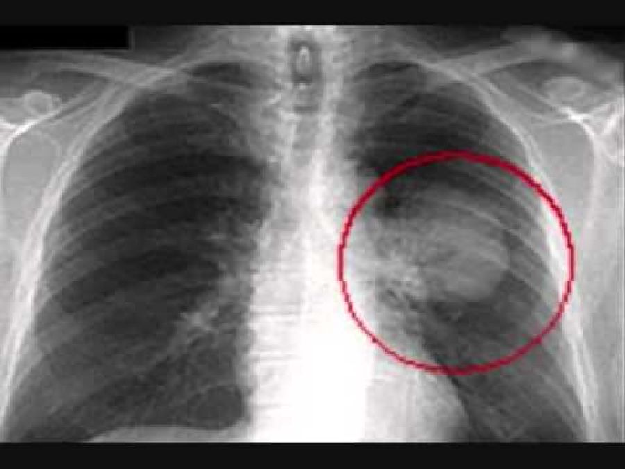 Comment reconnaître les signes précoces de cancer pulmonaire pour le prendre en charge dès le début
