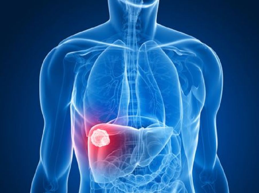 Les symptômes du cancer du foie que vous ne devriez jamais ignorer et ce que vous pouvez faire pour réduire votre risque