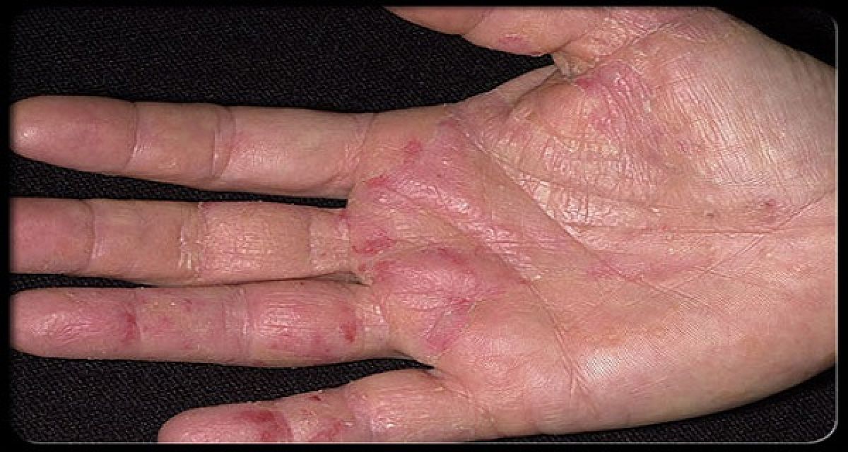 Les symptômes du cancer apparaissent d’abord sur vos mains : ne les ignorez pas !