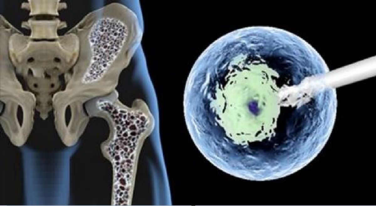 Cette nouvelle thérapie cellulaire peut prévenir le vieillissement osseux et traiter l’ostéoporose