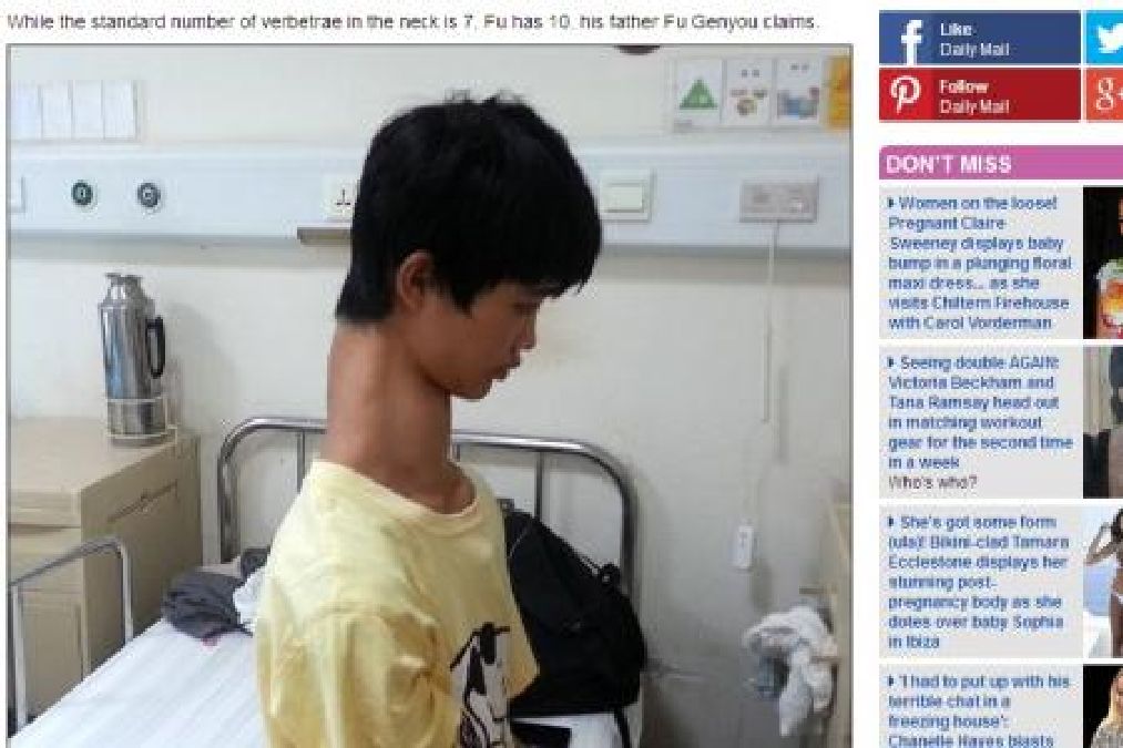 Son cou est anormalement long: une véritable torture pour ce chinois de 15 ans