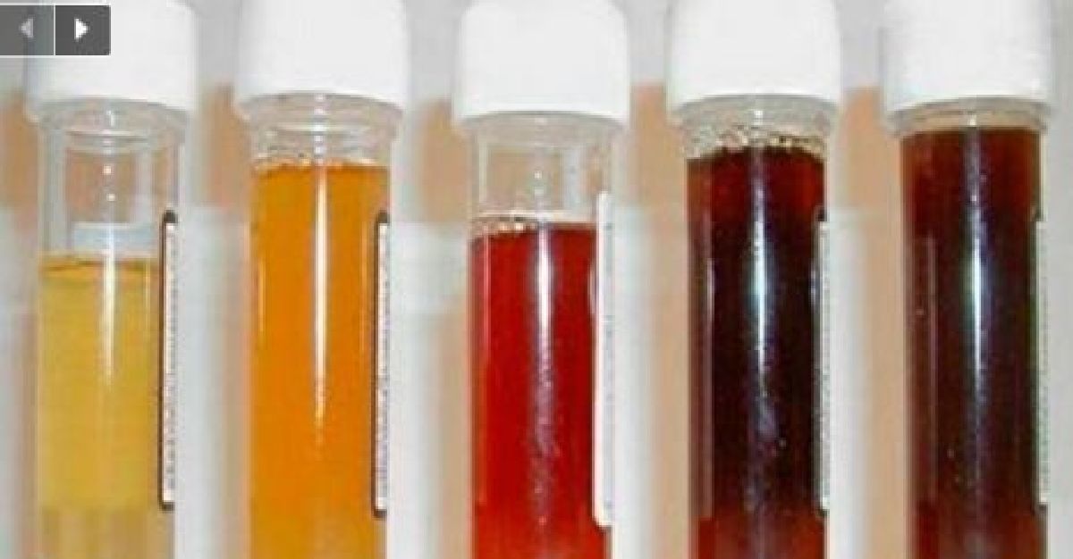 Ce que la couleur de votre urine révèle sur votre santé