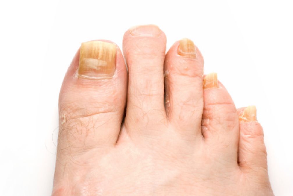 Débarrassez-vous des infections fongiques sur vos ongles à l’aide du ..