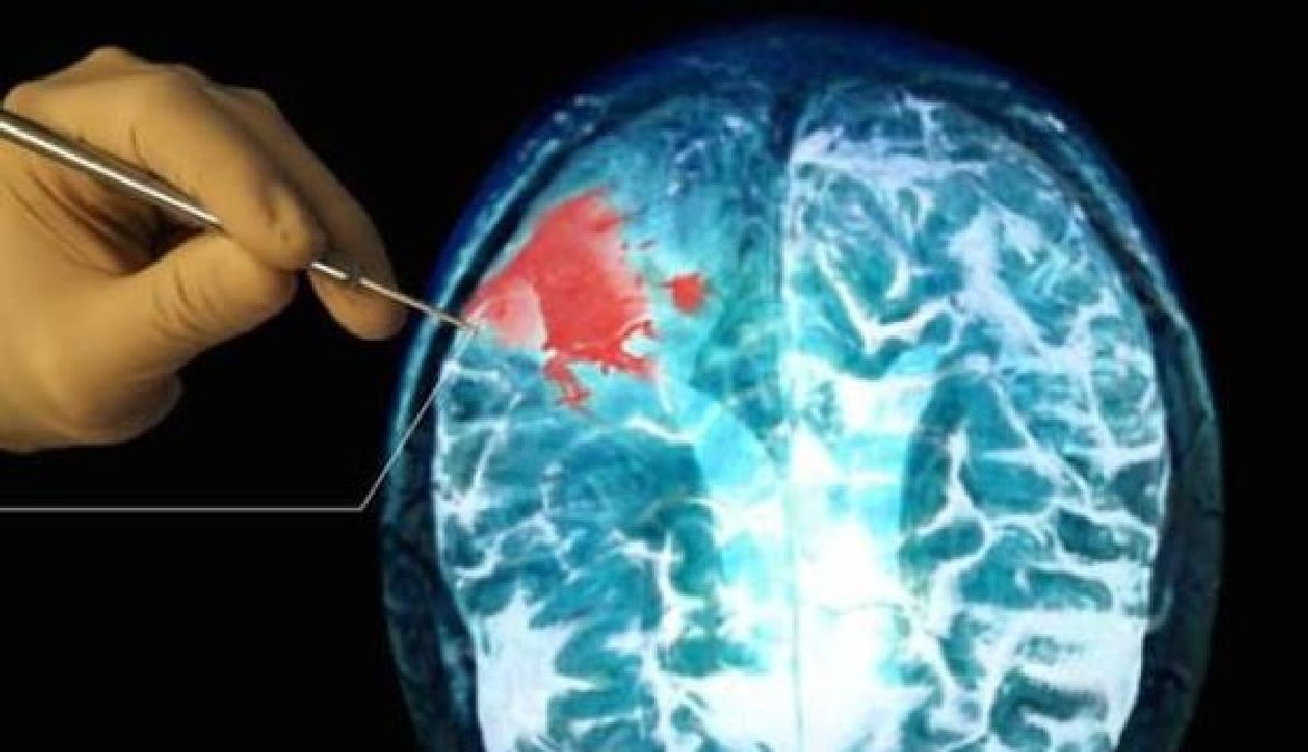 Cancer du cerveau : espoir de traitement grâce à un médicament utilisé contre le paludisme