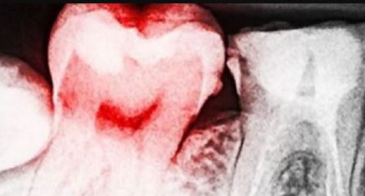 13 signes que vous avez une infection aux dents et comment la traiter sans aller chez le dentiste