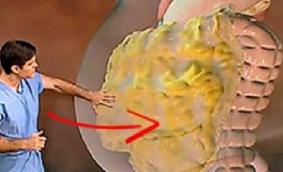 Comment se débarrasser des graisses du ventre en 3 étapes faciles : conseils de médecins