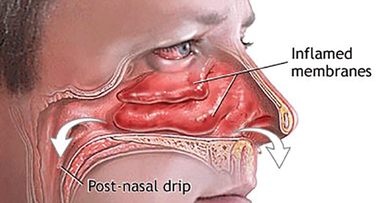 Remède-maison contre le nez bouché et les congestions nasales