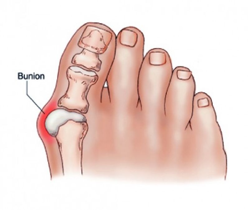 Comment se débarrasser des oignons aux pieds et des douleurs articulaires.