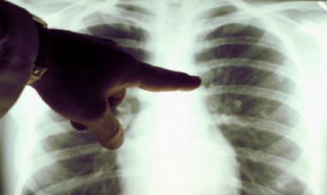 Pensant être atteint d’une tumeur, il découvre que cet objet insolite bloque ses poumons, depuis 40 ans !