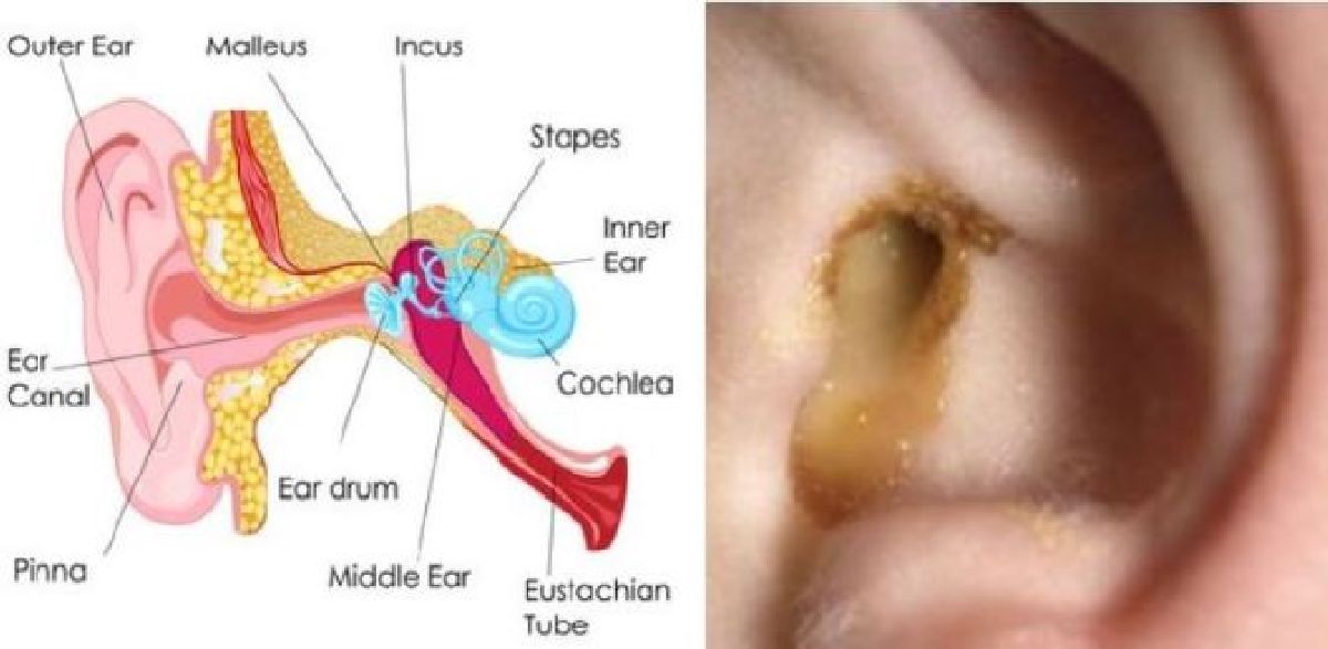 Comment guérir naturellement une infection  de l’oreille en une journée