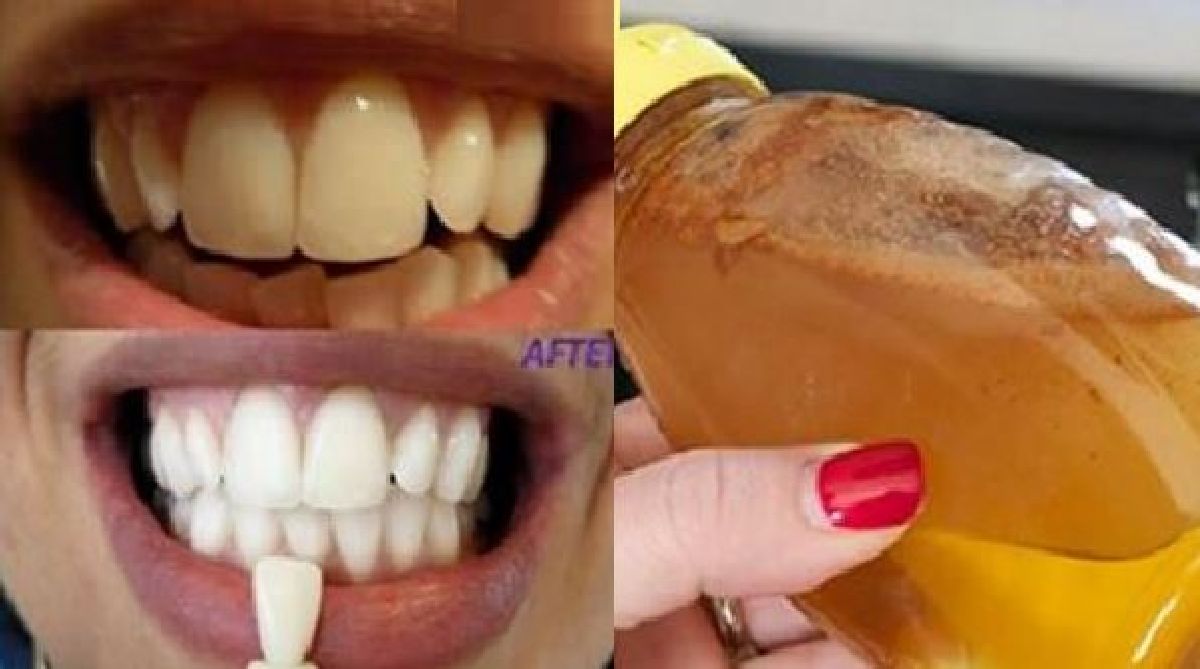 Gargarisez-vous avec ces ingrédients simples et voyez ce qui arrive à vos dents