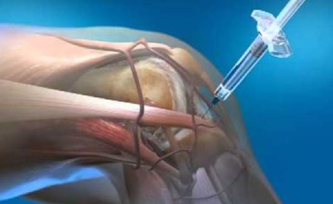 Arthrose : Les injection à base d’acide hyaluronique injectable du genou ne seront plus remboursés