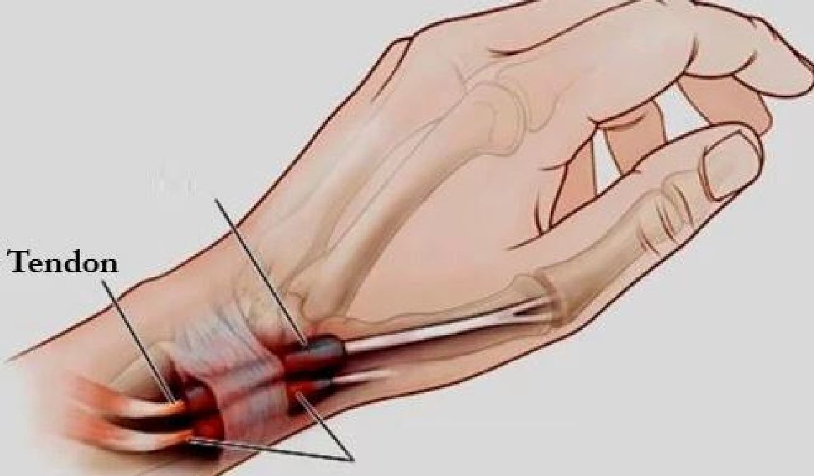 Tout ce que vous devez savoir sur la ténosynovite l’inflammation des mains et des pieds