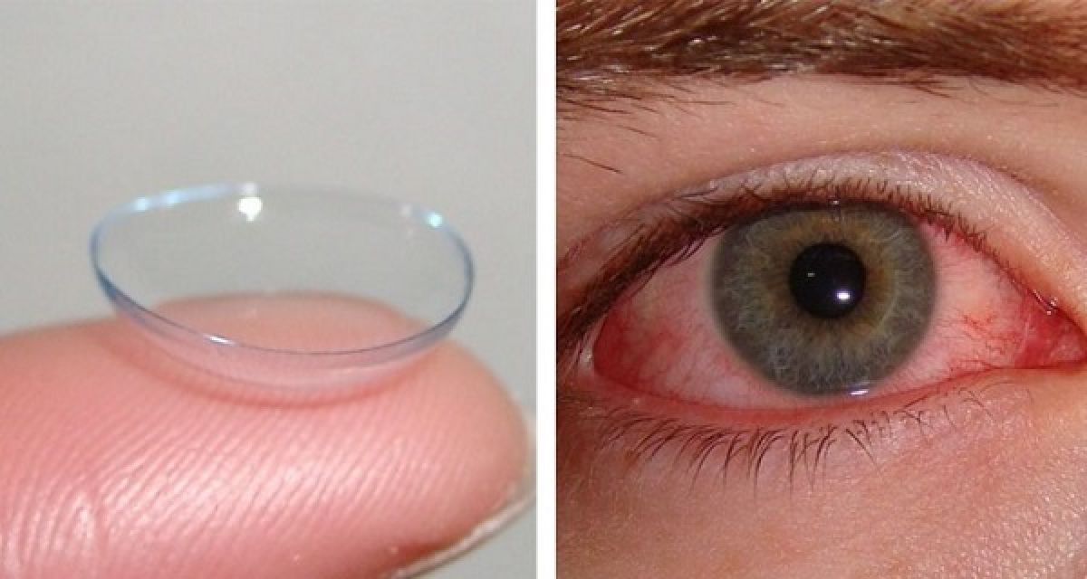 99%des personnes portant des lentilles de contact, les utilisent dangereusement mal, êtes -vous parmi ceux- là ?