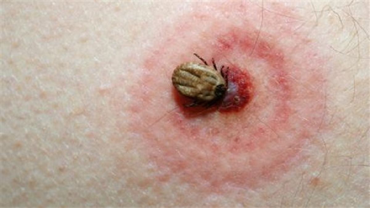Un nouveau cri d’alarme des médecins sur la maladie de Lyme