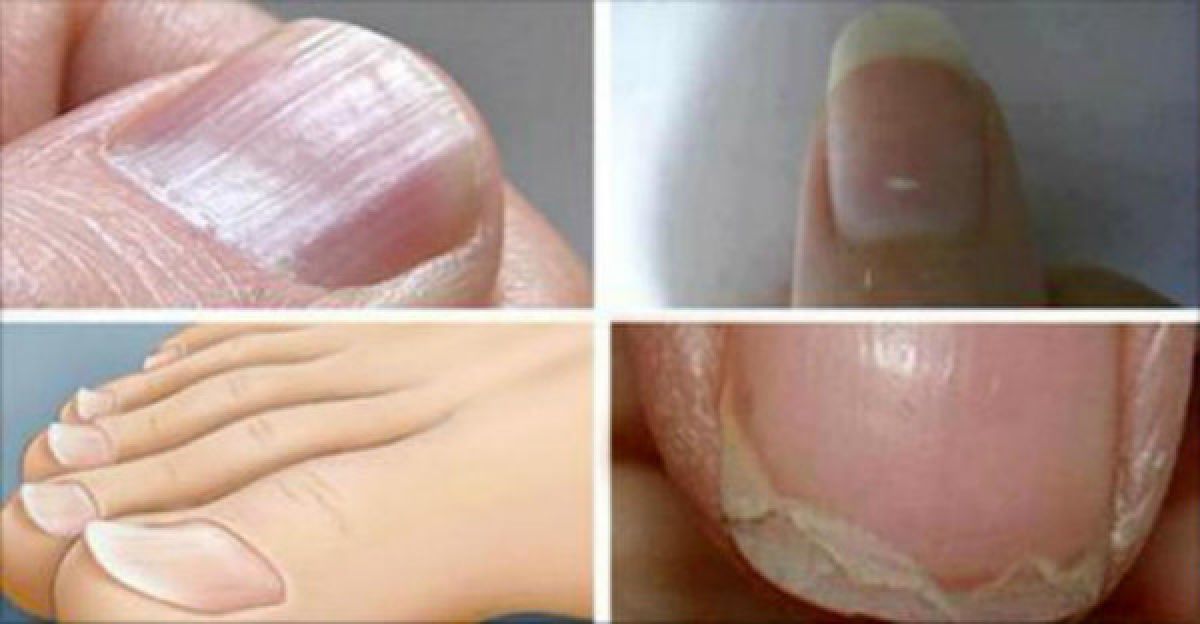 7 atteintes communes de l’ongle qui peuvent révéler des maladies graves !