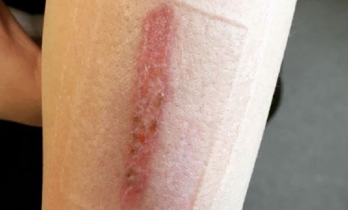 Si vous trouvez ces cicatrices sur la main de votre enfant réagissez vite !