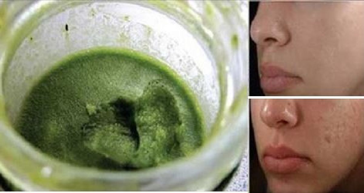 Cette pâte verte va faire disparaître les cicatrices d’acné de votre visage en seulement 3 jours