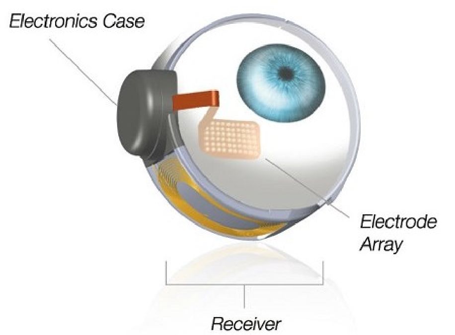 Un oeil bionique implanté pour la première fois sur des patients !