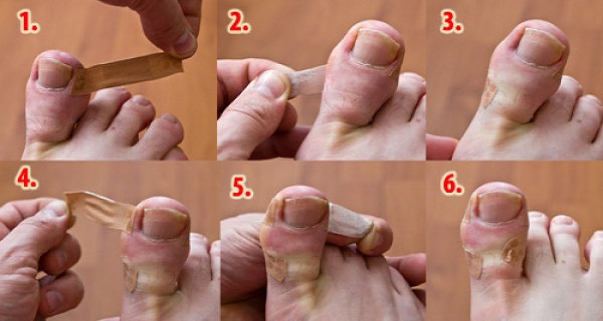 Traitement naturel des ongles incarnés simple et efficace !
