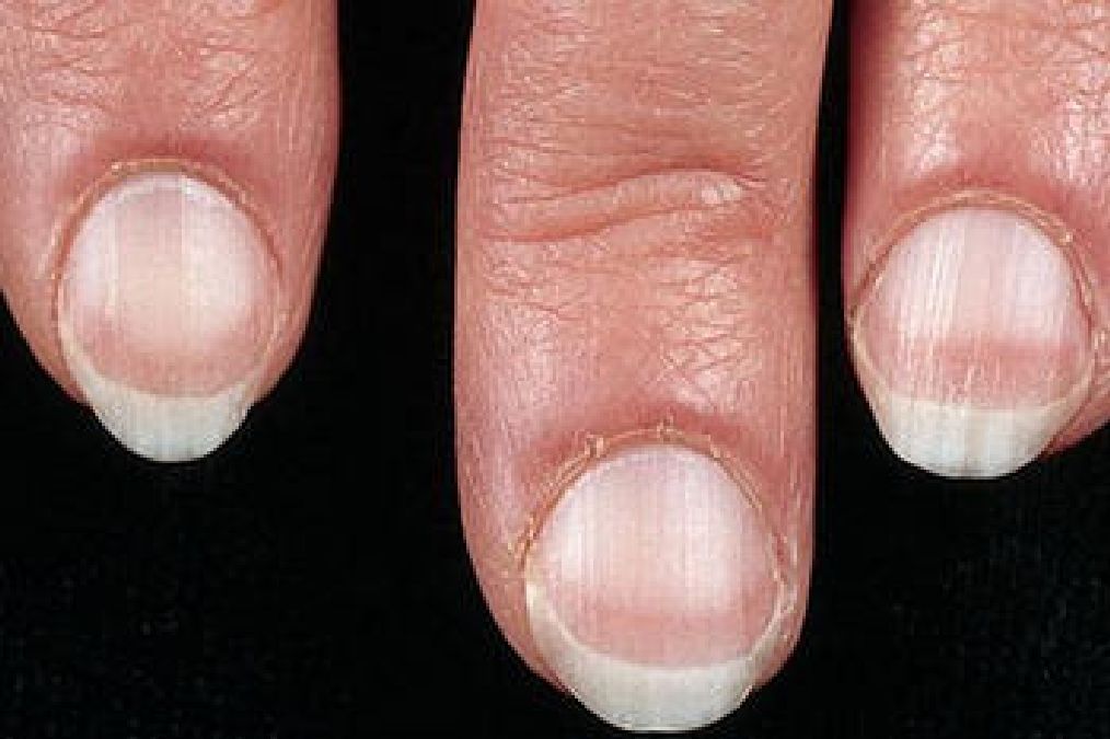Quand les ongles révèlent des maladies cachées :Ce que nos ongles disent sur notre santé