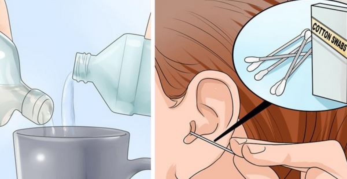 Eliminer efficacement le cérumen et les infections de l’oreille avec ces deux ingrédients.