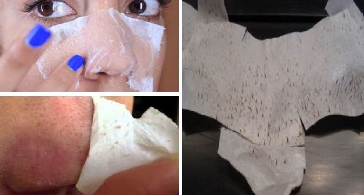 Faites vos propres patchs pour les pores – éliminez les points noirs et débarrassez-vous des pores dilatés et bouchés