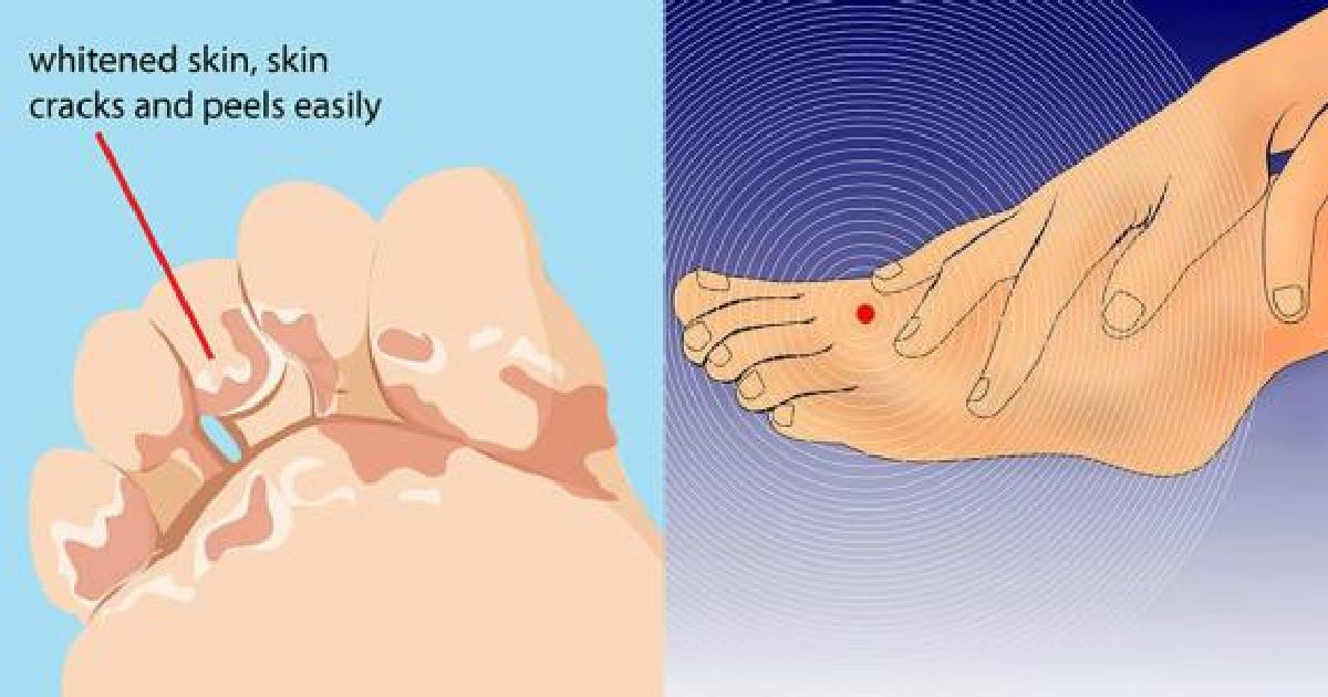 Ce que vos pieds révèlent sur votre tension artérielle, thyroïde et arthrite !