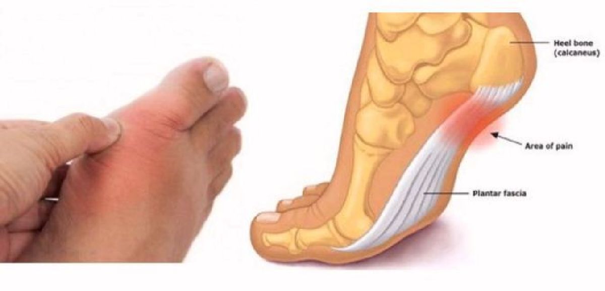 Découvrez ce que disent vos pieds sur votre tension artérielle, thyroïde et  arthrite
