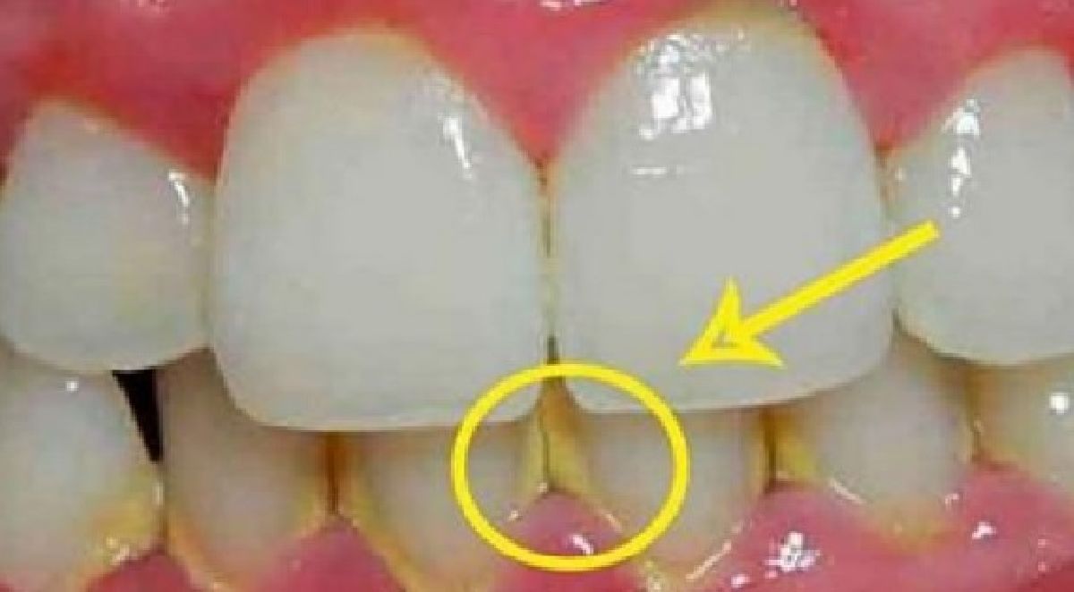 Comment éliminer la plaque dentaire en 5 minutes naturellement, sans aller chez le dentiste !