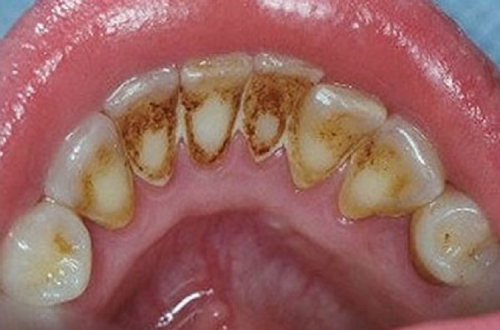 Comment se débarrasser des plaques dentaires sans dentiste
