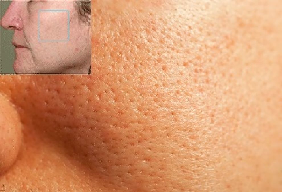 Remèdes de Grand-mère pour  en finir avec les pores dilatés