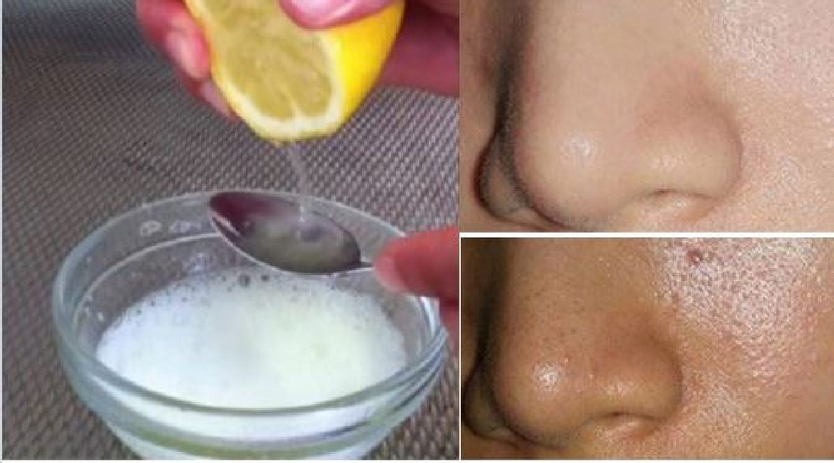 Utilisez seulement ces 2 ingrédients et vos pores seront plus nettoyés que jamais!