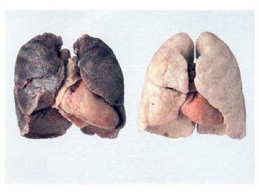 Tabac : Comment nettoyer ses poumons  naturellement  ?