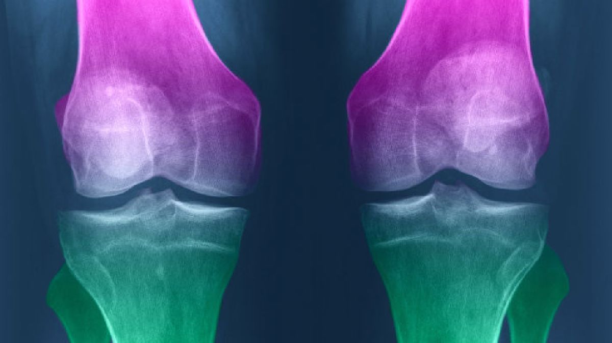 Comment régénerer le cartilage du genou naturellement