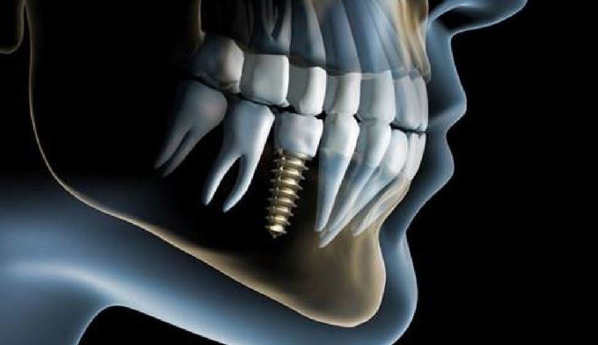 Adieu l’implant dentaire ! Rétablissez votre dentition naturellement en 9 semaines seulement !