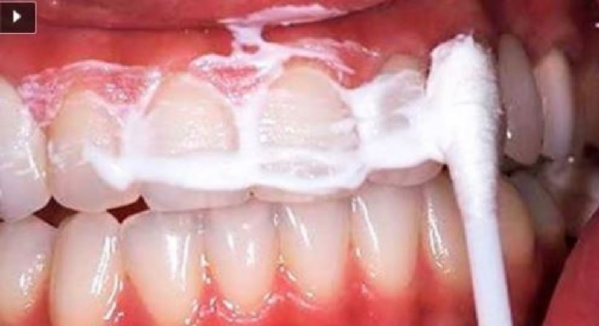Rincez votre bouche pendant 60 secondes avec ce mélange et éliminez le tartre et la plaque de vos dents!